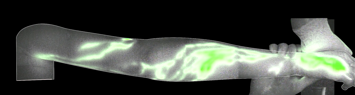 Upper extremity under near infrared light for ICG lymphography