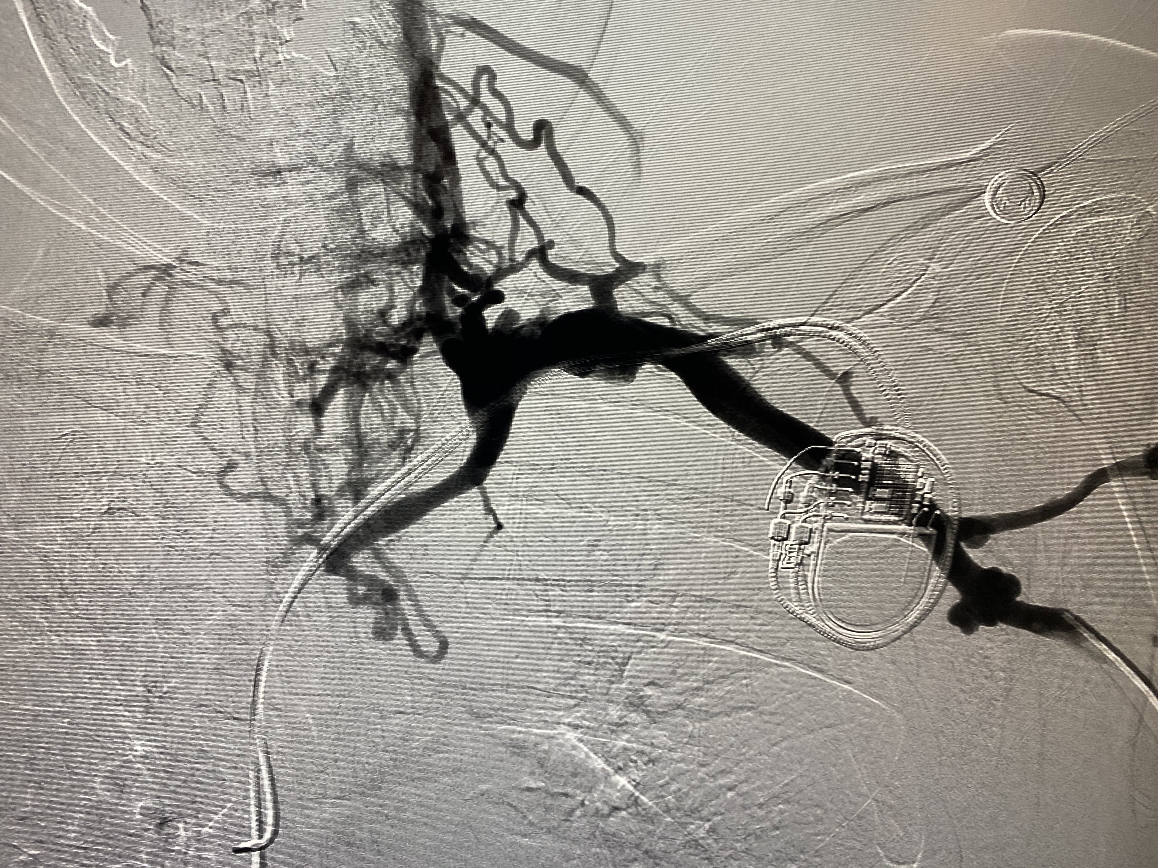 Image of vasculature with contrast