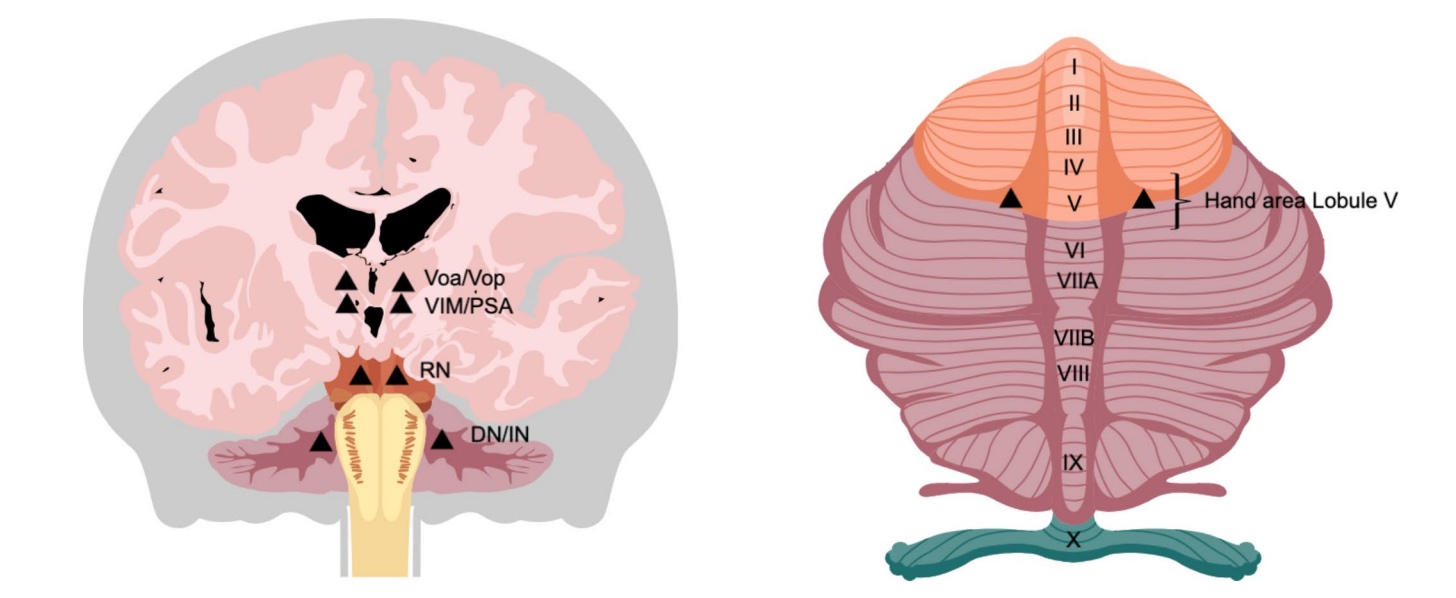 Image of brain with stimulation sites for tremor