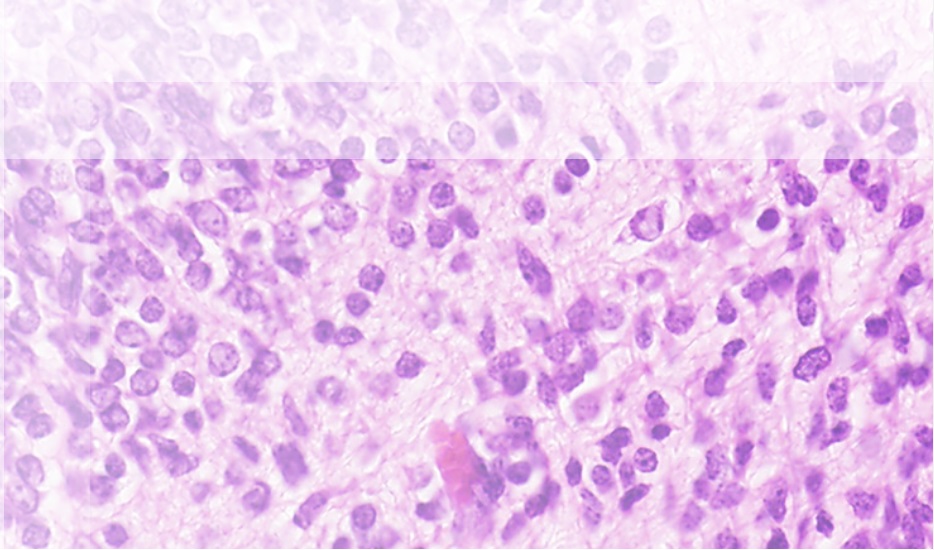 Epithelioid cell GIST stained by hematoxylin eosin