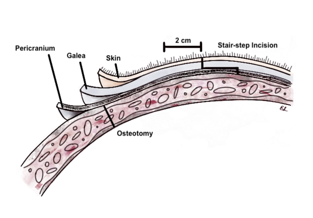 Cranial stair-step incision for minimizing postoperative complications in neuro-oncologic surgery