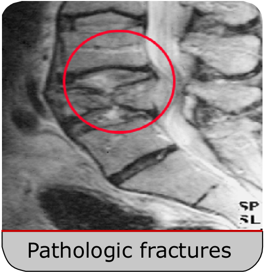 metastatic-spine-research