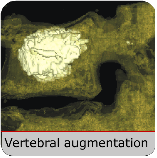 Vertebral Augmentation