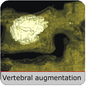 Vertebral Augmentation