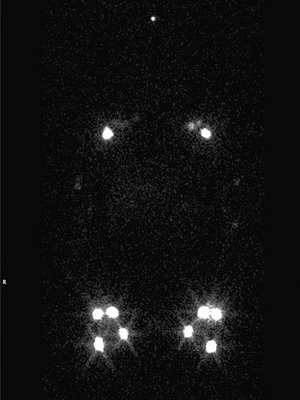 lymphoscintigraphy