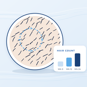 Drawing of scalp hairs under a lens next to a hair count chart