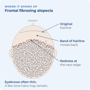 Diagram: map frontal fibrosing alopecia