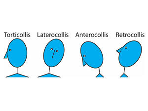 cervical dystonia picture