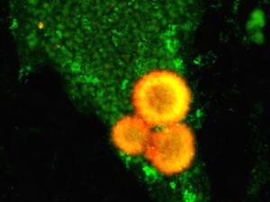 pas-lewy-bodies-in-green-nerve-cell