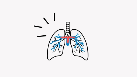 Line drawing of pulmonary embolism (clot in lungs)