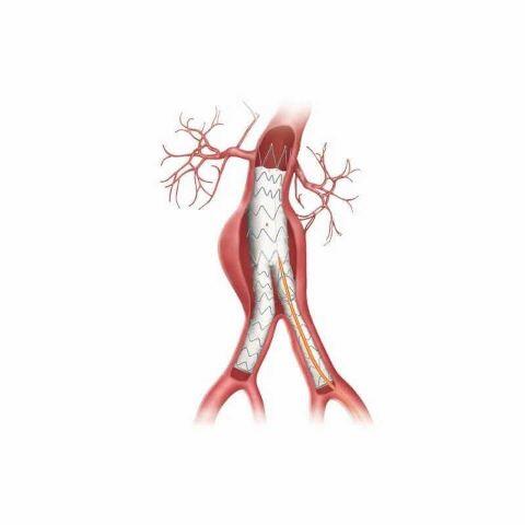 Drawing of abdominal aorta
