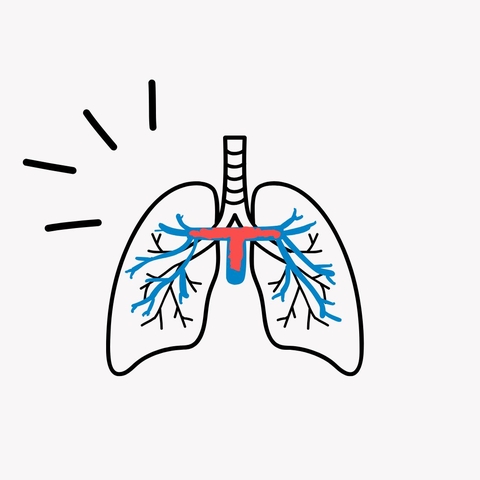 Line drawing of pulmonary embolism (clot in lungs)