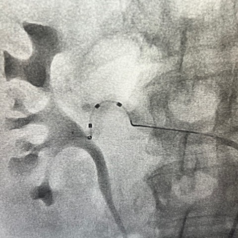 Radiology image of renal denervation procedure 