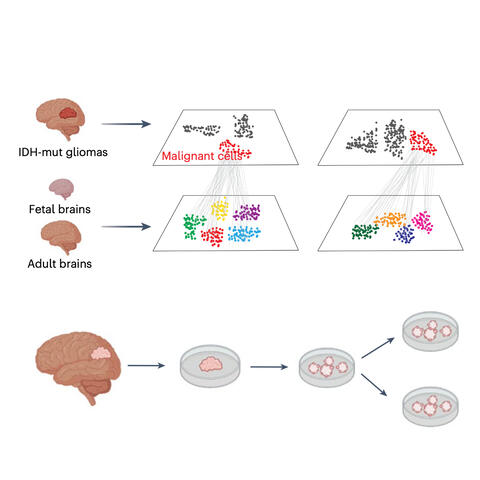 glioma