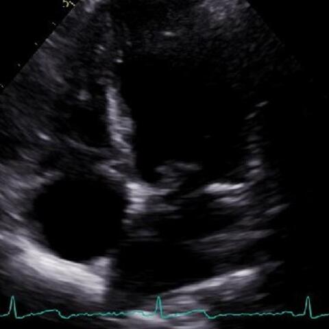 echocardiogram