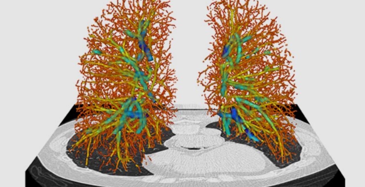 Pulmonary Vascular Pruning on CT 