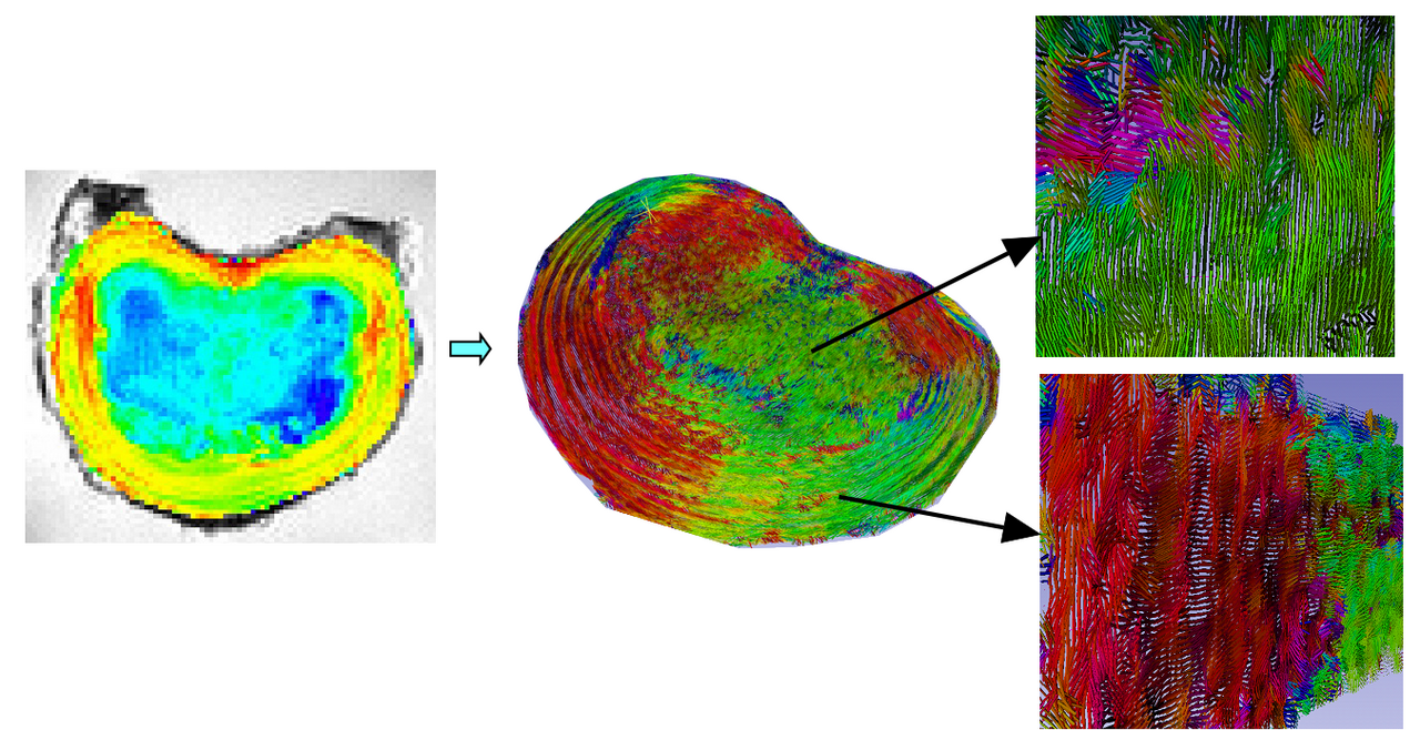 Intervertebral disc MR Diffusion imaging