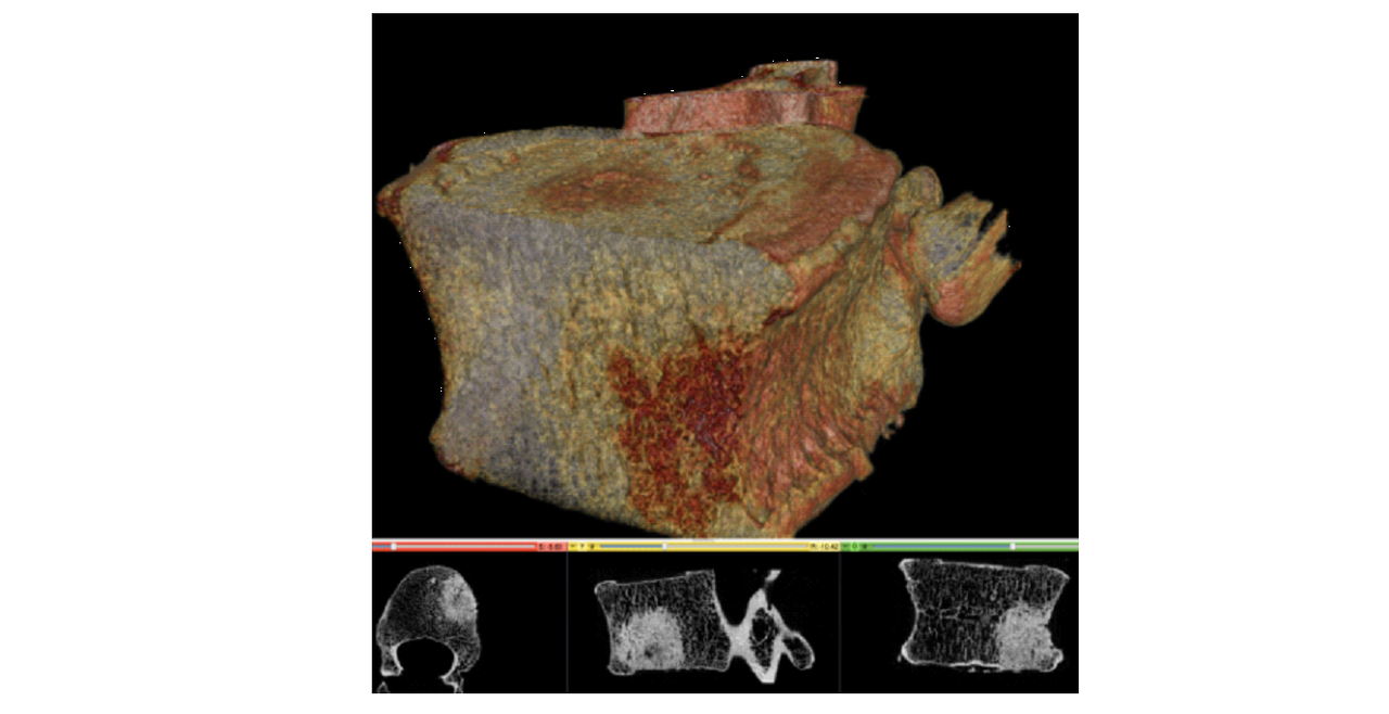 Metastatic vertebrae