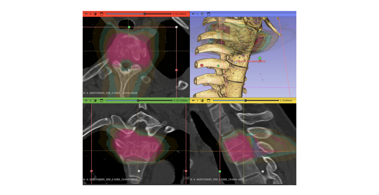 Radiotherapy planning