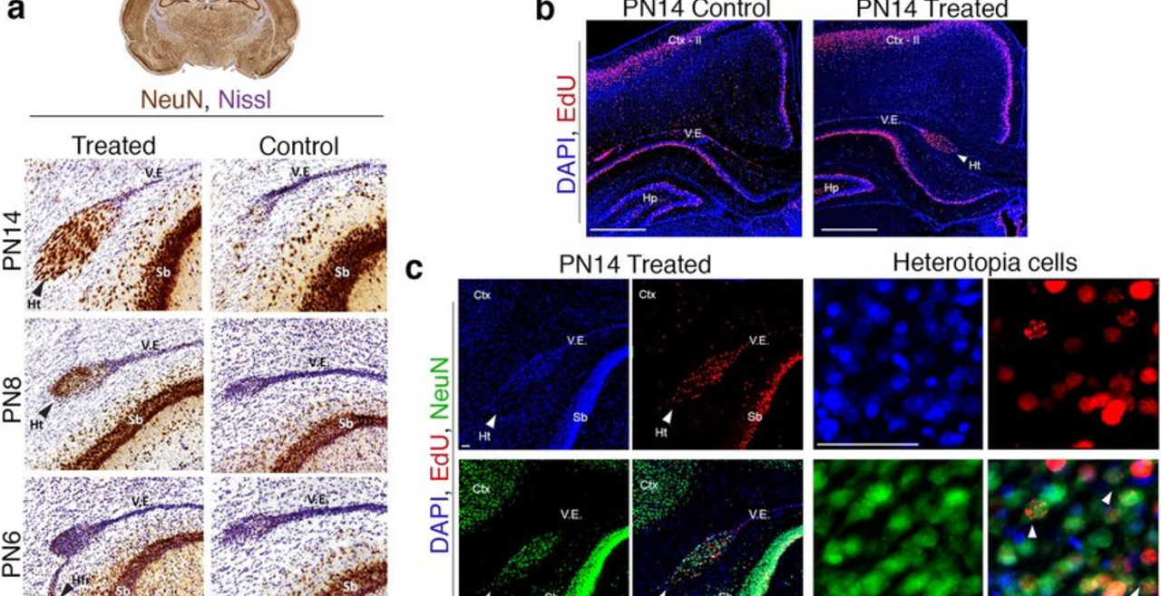 Periventricular Heterotopia