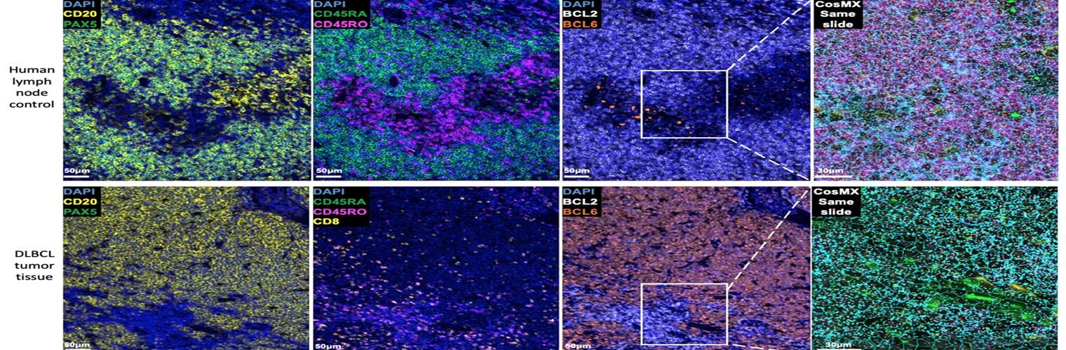 in-depth dlbcl