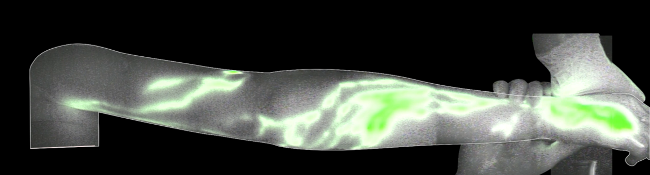 Upper extremity under near infrared light for ICG lymphography