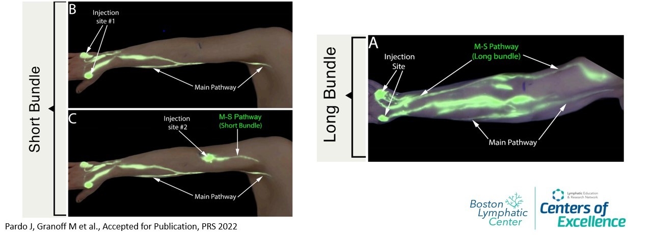M-S Pathway on ICG lymphography