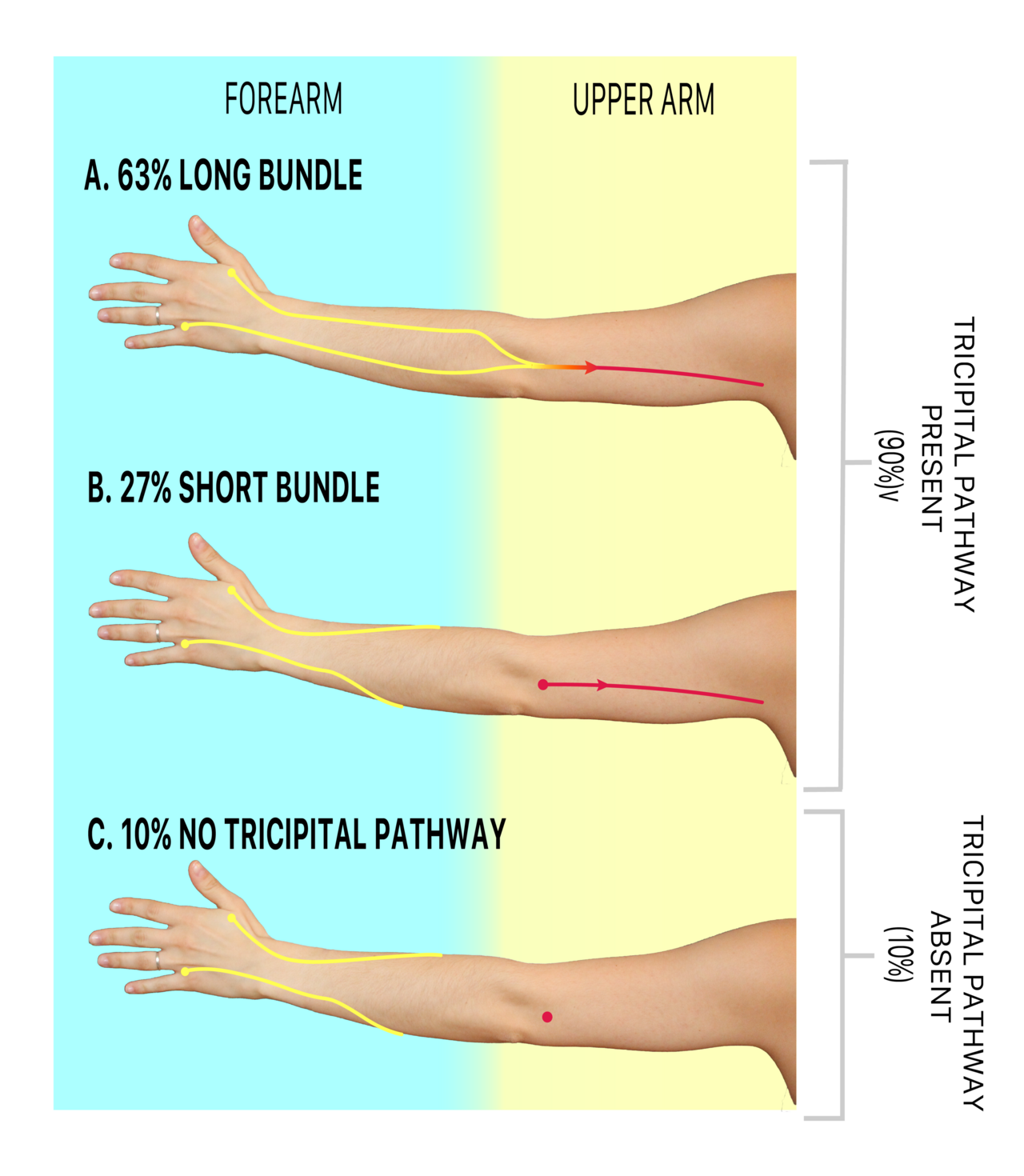 Tricipital figure from Breast Cancer Research and Treatment, Jan. 2023