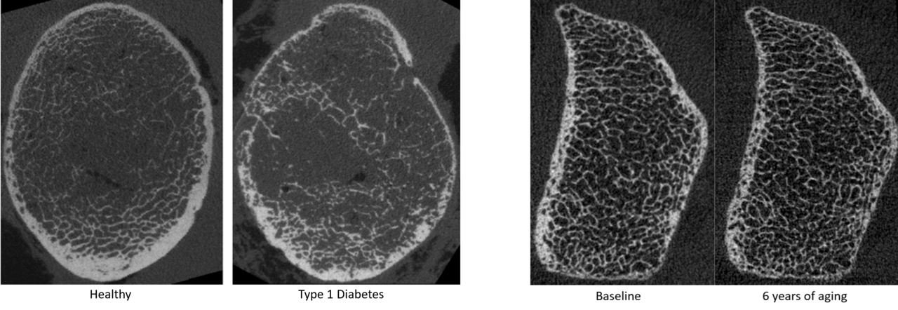 hrpqct images