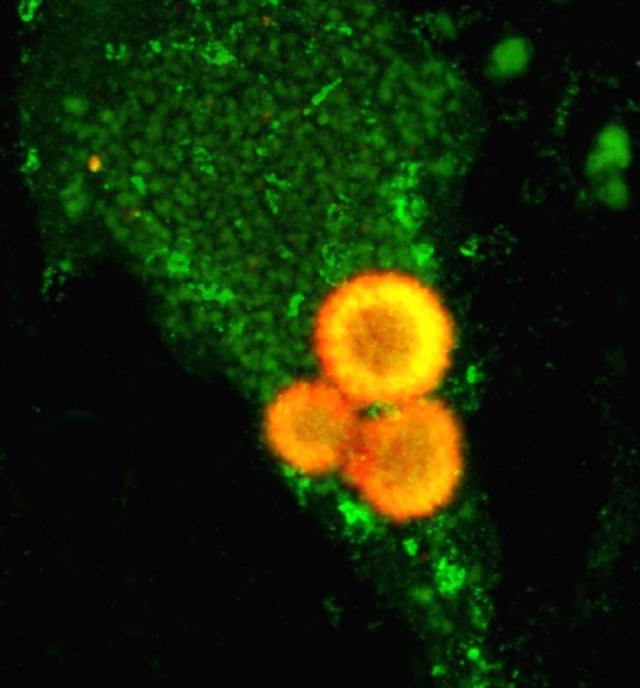 pas-lewy-bodies-in-green-nerve-cell