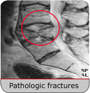 metastatic-spine-research