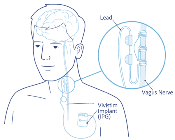 Vivistim Device