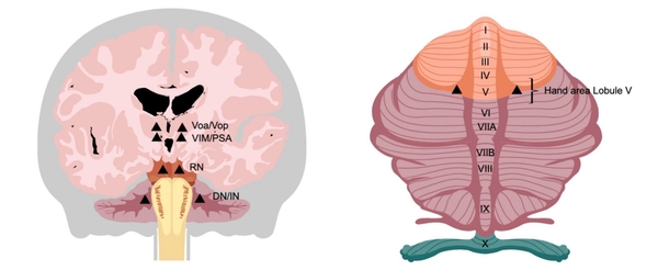 Image of brain with stimulation sites for tremor