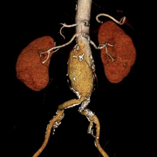 Abdominal Aortic Aneurysm