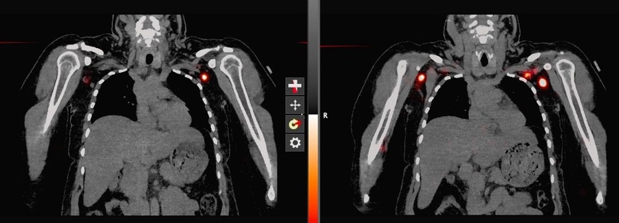 SPECT CT