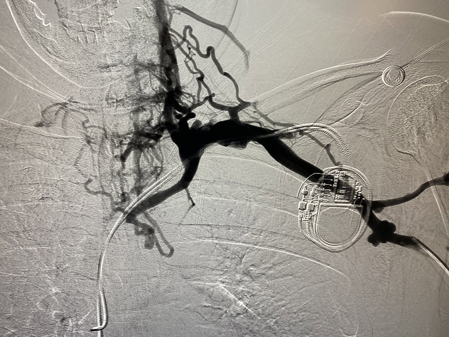 Image of vasculature with contrast